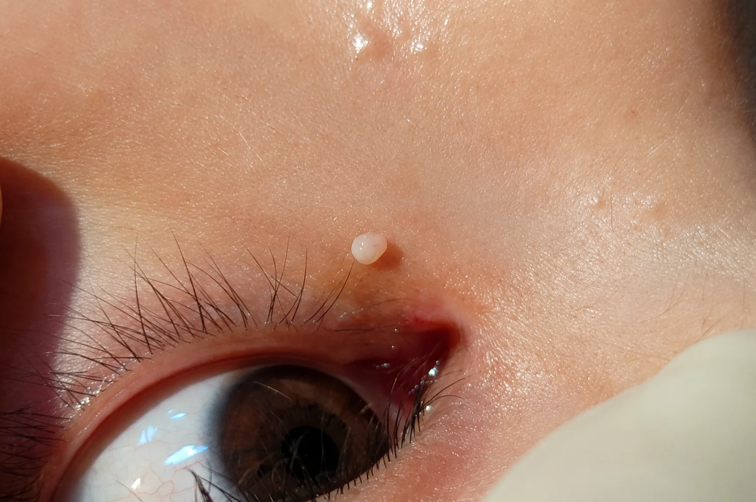 稗粒腫の施術後の様子（実際の写真）