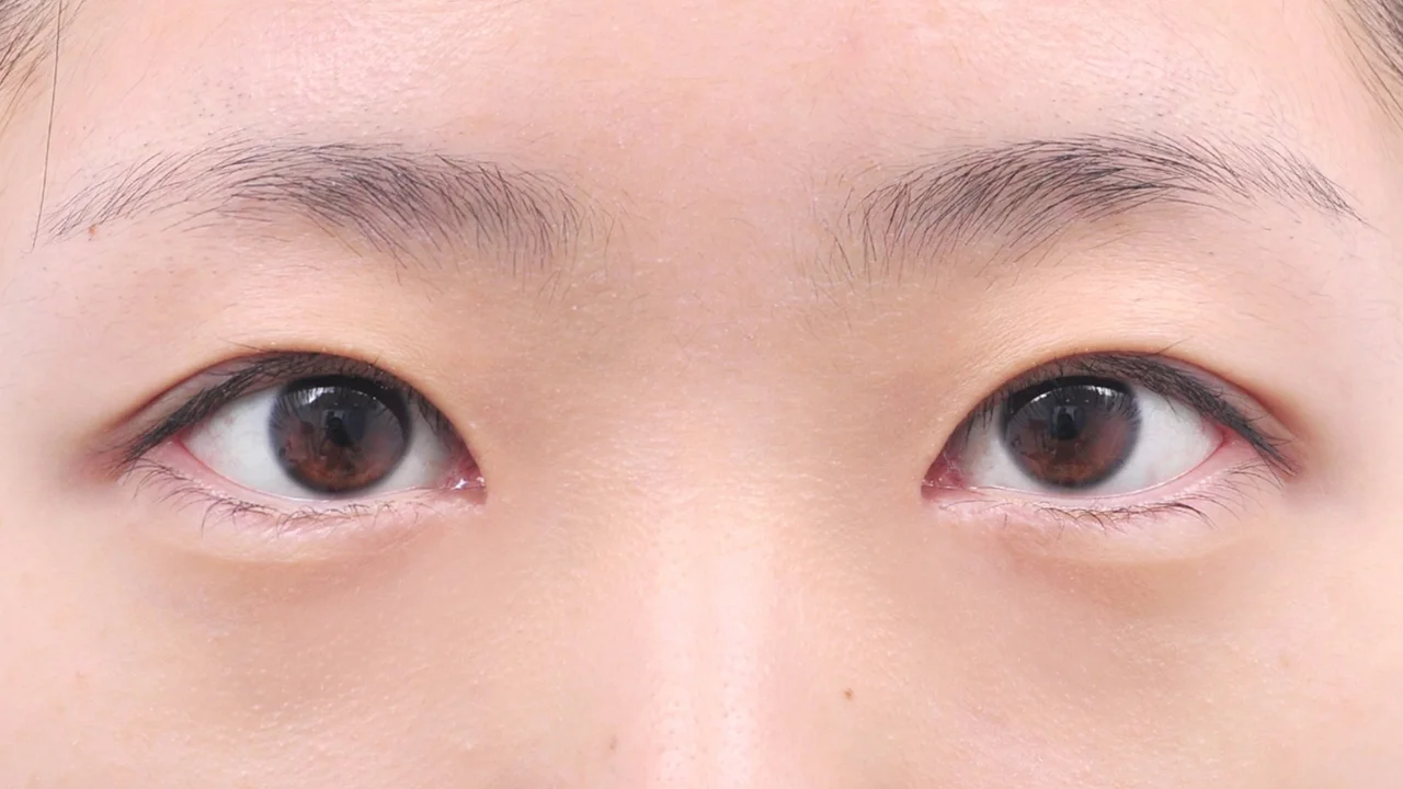 術後1ヶ月の目もと（症例写真）