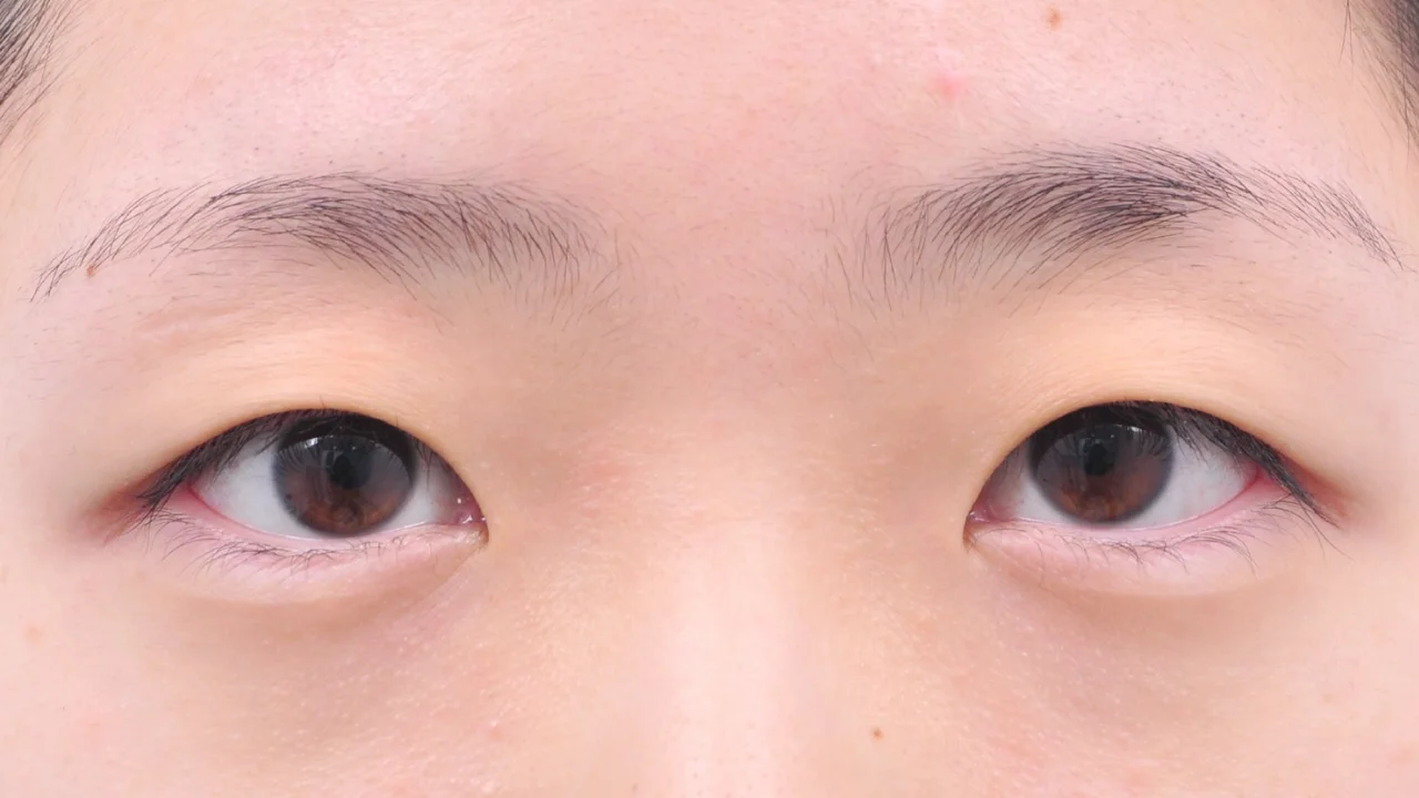 術前の目もと（症例写真）