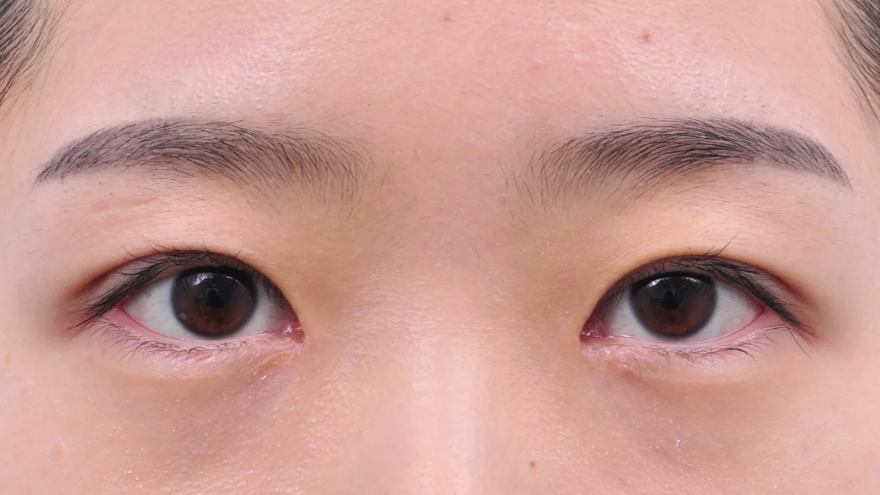 術後14日の目もと（症例写真）