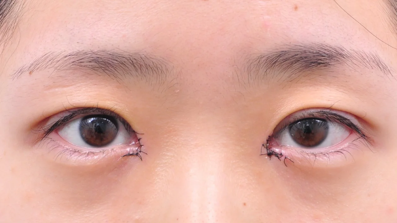 術後2日の目もと（症例写真）