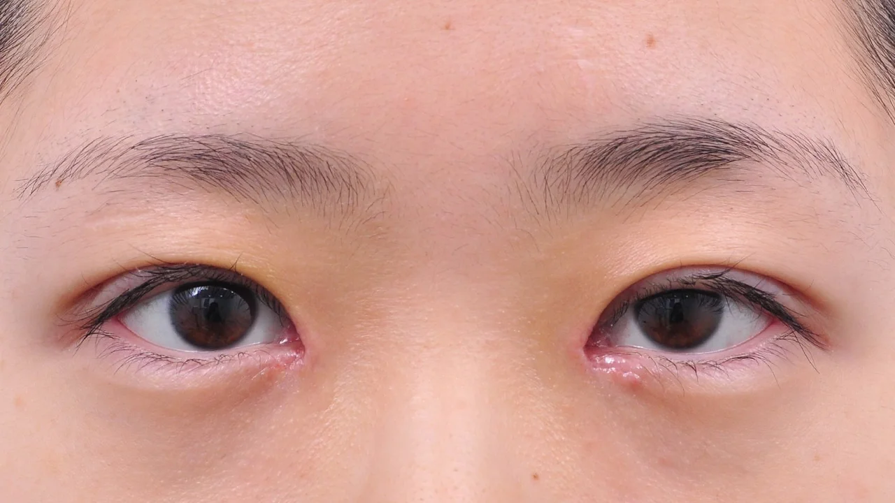 術後6日の目もと（症例写真）