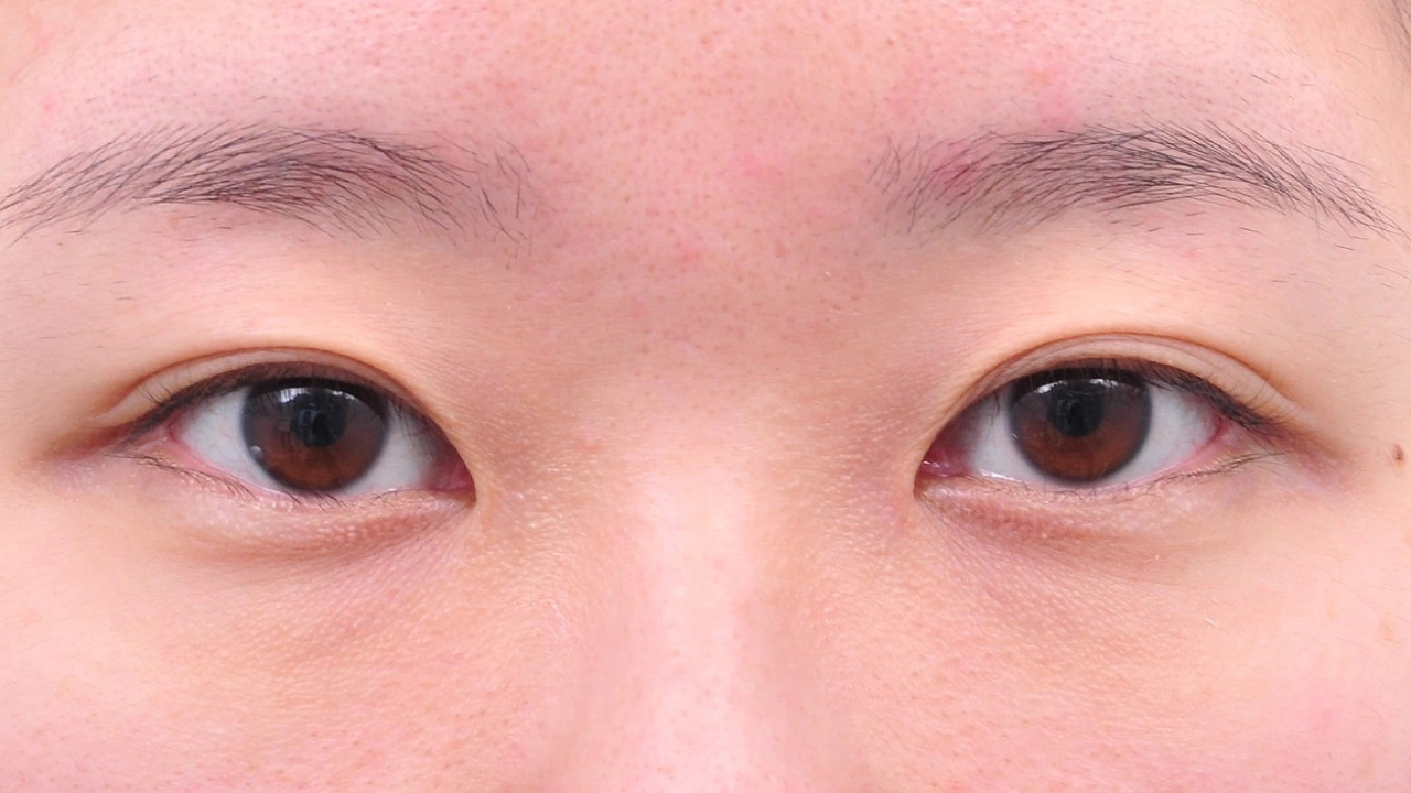 GL目元形成術＋眼瞼内反症（逆さまつげ）矯正 施術前（症例写真）｜OLO美容外科