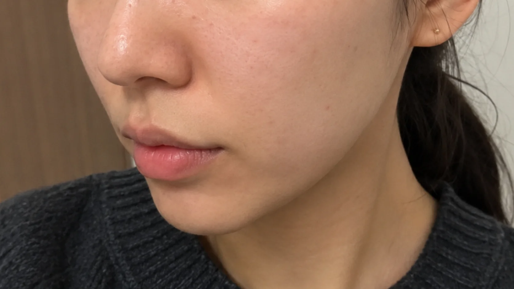 症例B ポテンツァ美肌再生セット 施術前の肌（臨床写真）｜OLO美容外科