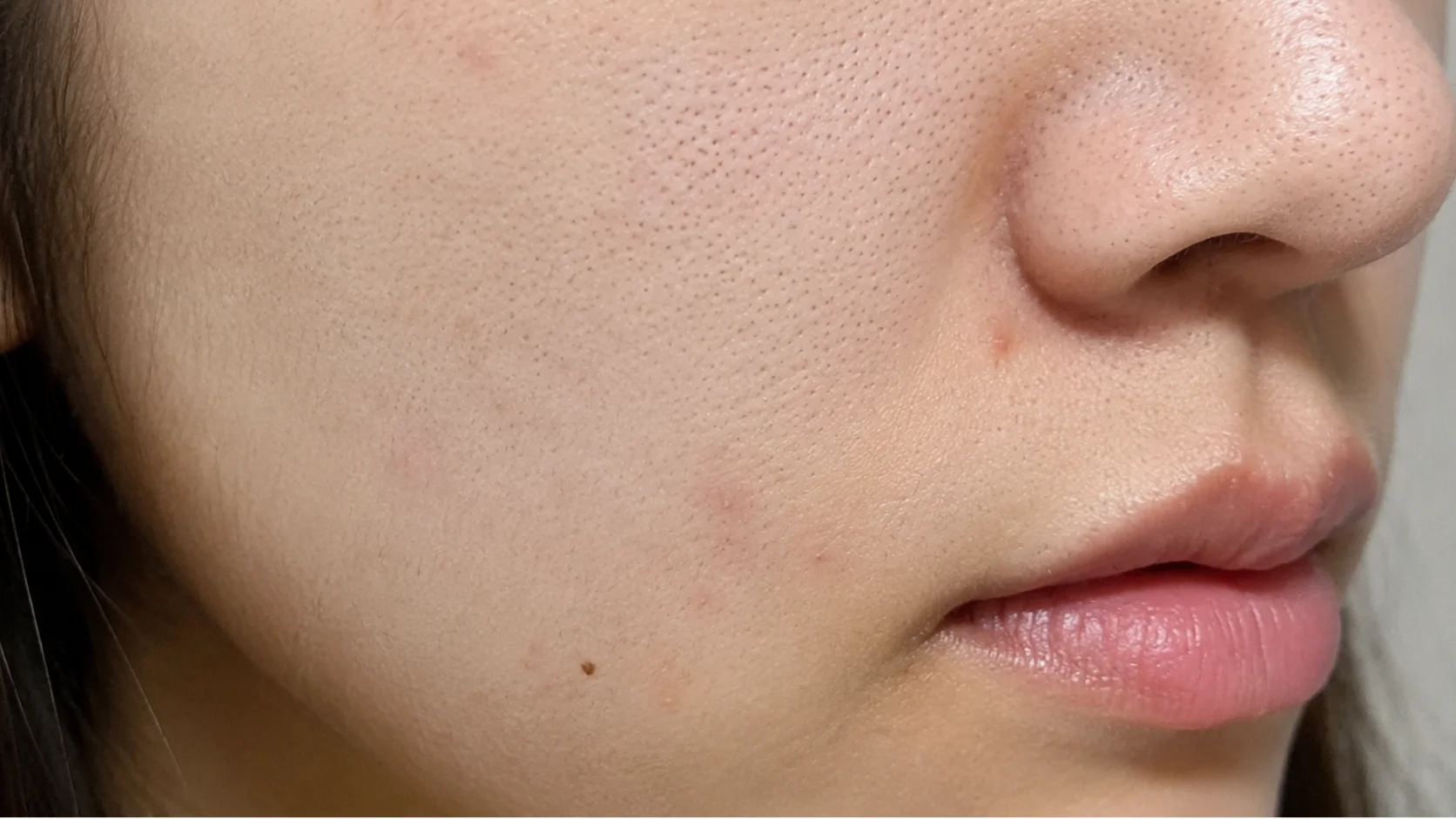 症例A スキンボトックス美肌セット 施術前の肌（臨床写真）｜OLO美容外科
